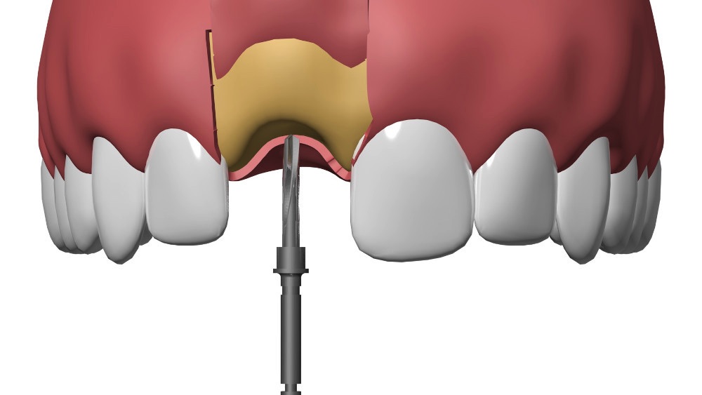 Implant dentaire Nimes cabinet dentaire Nimes